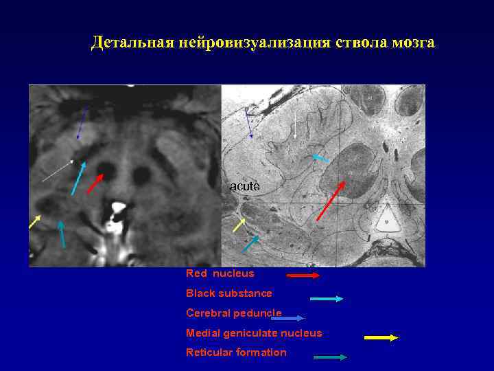 Детальная нейровизуализация ствола мозга acute МРТ Red nucleus Black substance Cerebral peduncle Medial geniculate