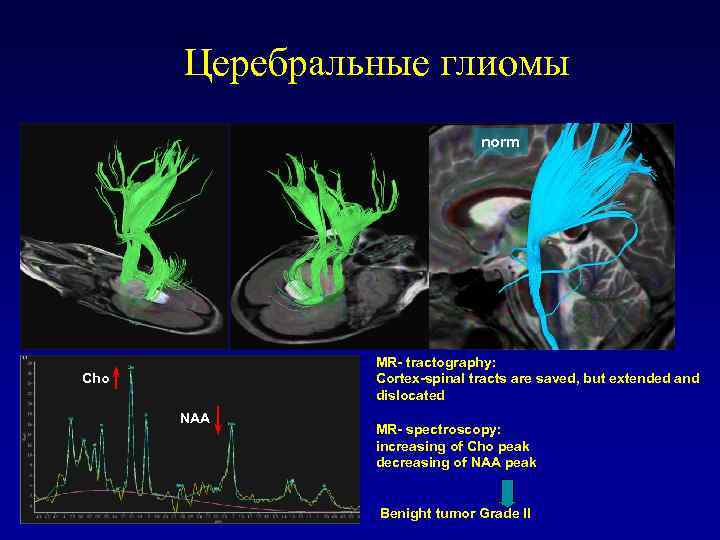 Церебральные глиомы norm МR- tractography: Cortex-spinal tracts are saved, but extended and dislocated Cho