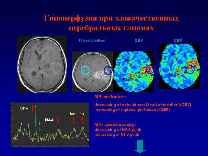 Гипоперфузия при злокачественных церебральных глиомах Т 1 post-contrast CBV CBF МR-perfusion: Cho lac lip