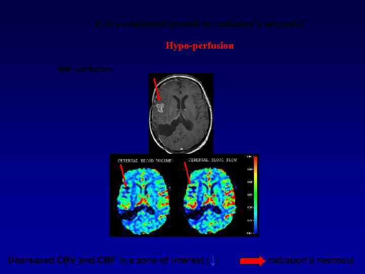 Is It a continued growth or radiation’s necrosis? Hypo-perfusion МR- perfusion Decreased CBV and