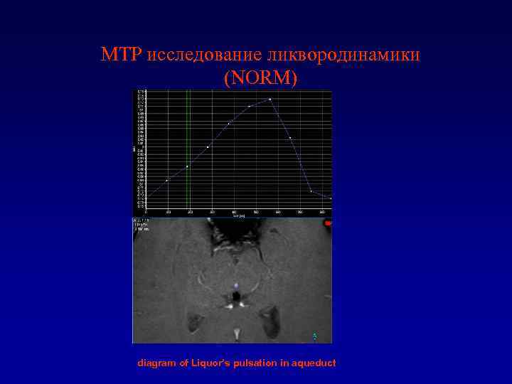 МТР исследование ликвородинамики (NORM) diagram of Liquor’s pulsation in aqueduct 