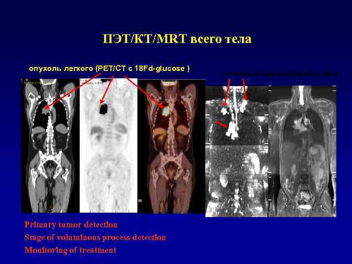 ПЭТ/КТ/МRТ всего тела опухоль легкого (PEТ/CТ с 18 Fd-glucose ) Primary tumor detection Stage