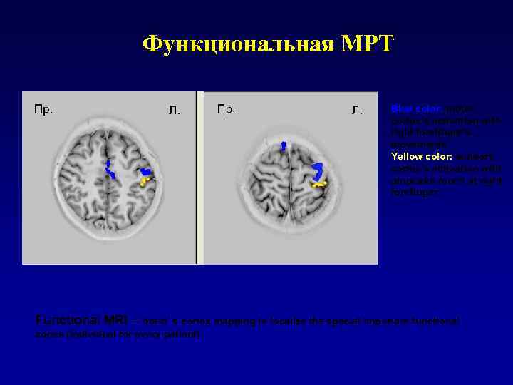 Функциональная МРТ Blue color: motor cortex’s activation with right forefinger’s movements Yellow color: sensory