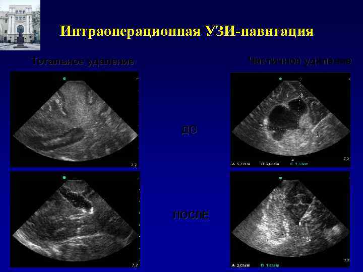 Интраоперационная УЗИ-навигация Частичное удаление Тотальное удаление ДО ПОСЛЕ 