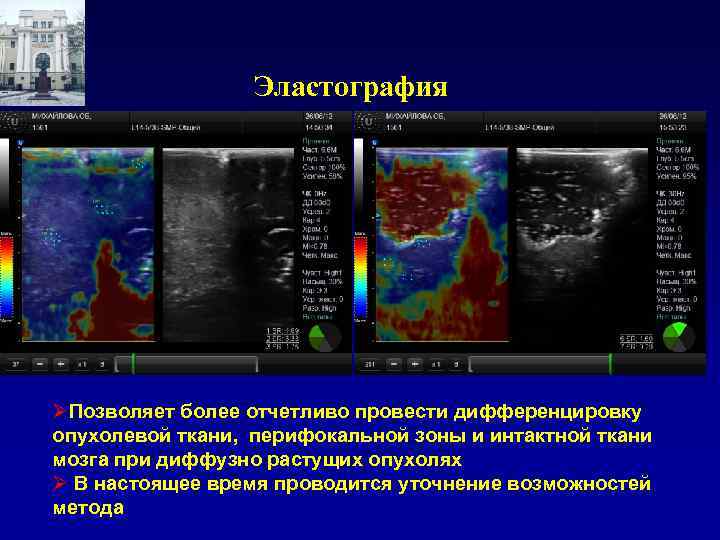 Эластография ØПозволяет более отчетливо провести дифференцировку опухолевой ткани, перифокальной зоны и интактной ткани мозга