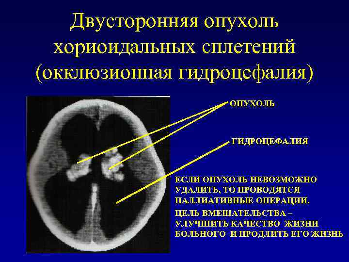 У плода киста мозга сплетения. Хориоидальная щель в головном мозге. Окклюзионная гидроцефалия опухоль.. Киста заднего рога бокового желудочка.