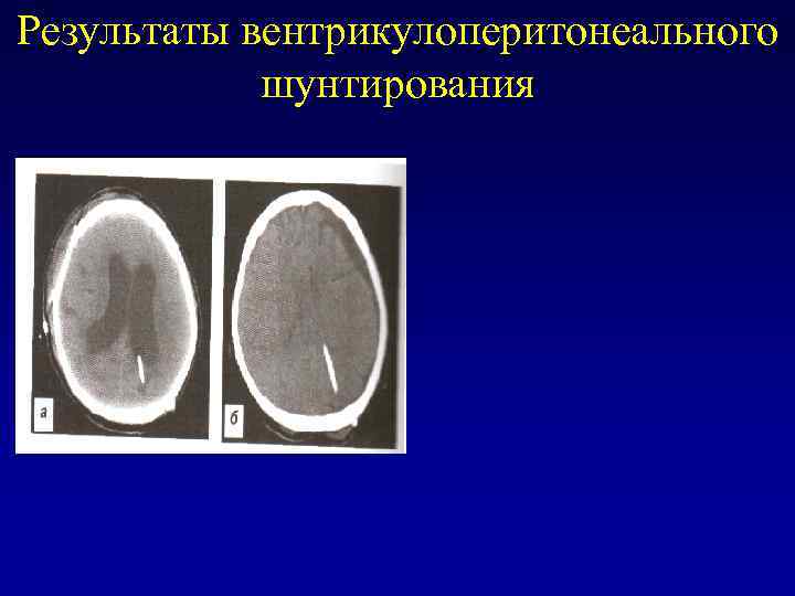 Результаты вентрикулоперитонеального шунтирования 