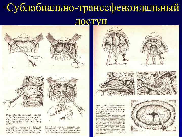  • Сублабиально-транссфеноидальный доступ 