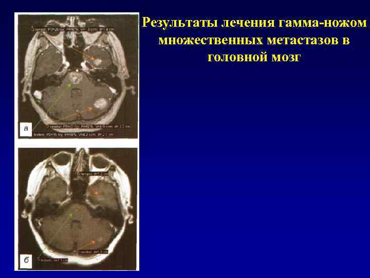 Лечение метастазов мозга. Метастазы в головном мозге. Метастаз галавной мозге.