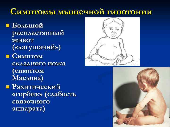 Синдром вялого ребенка. Симптомы мышечной гипотонии у детей. Мышечная гипотония симптомы. Синдром мышечной гипотонии. Синдром диффузной мышечной гипотонии.