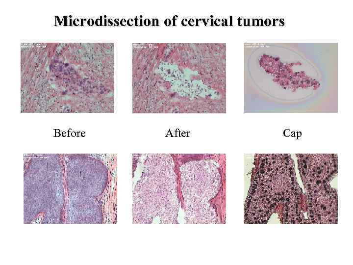 Microdissection of cervical tumors Before After Cap 