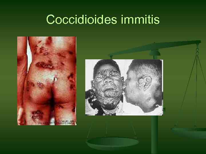 Coccidioides immitis 