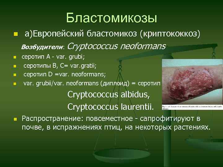 Бластомикозы n а)Европейский бластомикоз (криптококкоз) Возбудители: Cryptococcus n n neoformans серотип A - var.