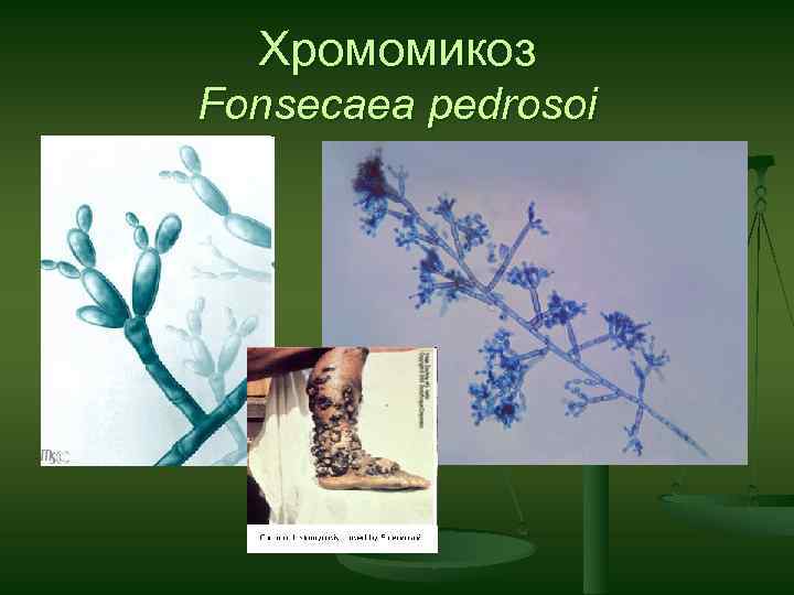 Хромомикоз Fonsecaea pedrosoi 