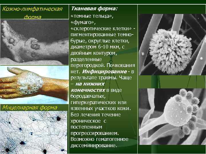 Кожно-лимфатическая форма Мицелиарная форма . Тканевая форма: «темные тельца» , «фумаго» , «склеротические клетки»
