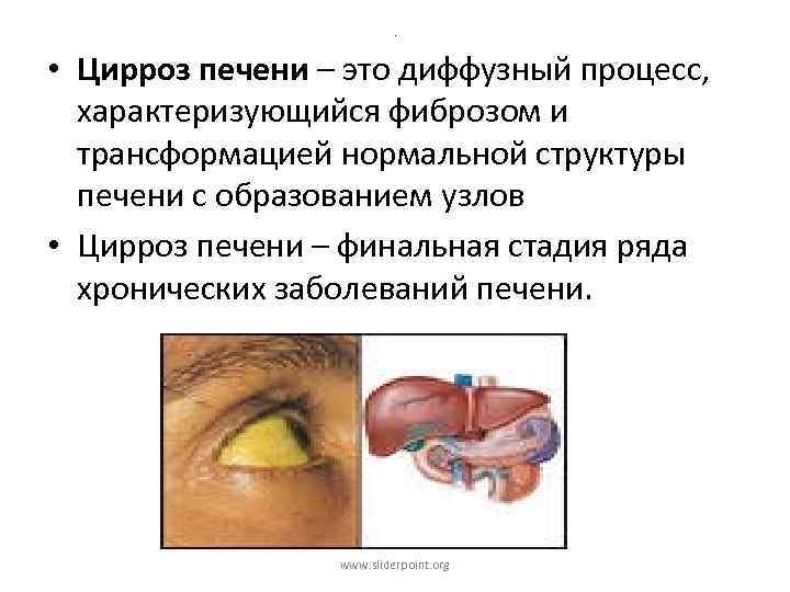 . • Цирроз печени – это диффузный процесс, характеризующийся фиброзом и трансформацией нормальной структуры