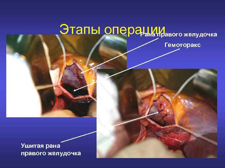 Этапы операции желудочка Рана правого Гемоторакс Ушитая рана правого желудочка 