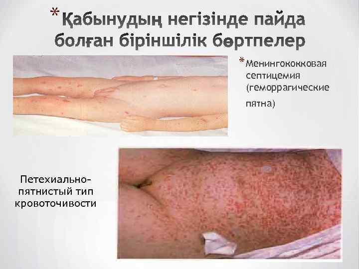 * * Менингококковая септицемия (геморрагические пятна) Петехиальнопятнистый тип кровоточивости 