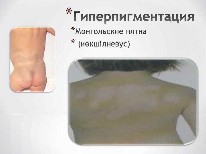 * *Монгольские пятна * (көкшілневус) 