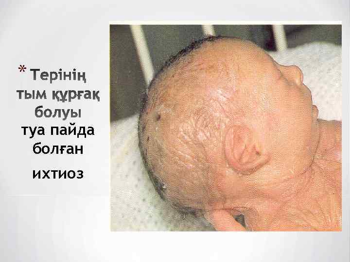 * туа пайда болған ихтиоз 