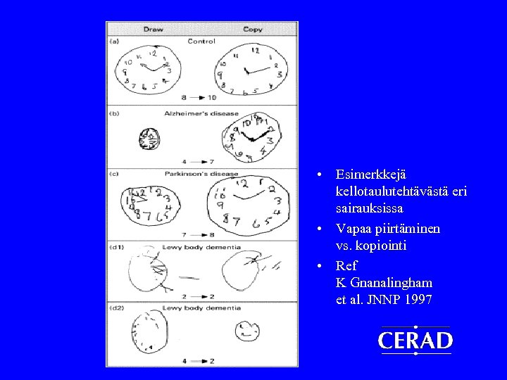  • Esimerkkejä kellotaulutehtävästä eri sairauksissa • Vapaa piirtäminen vs. kopiointi • Ref K