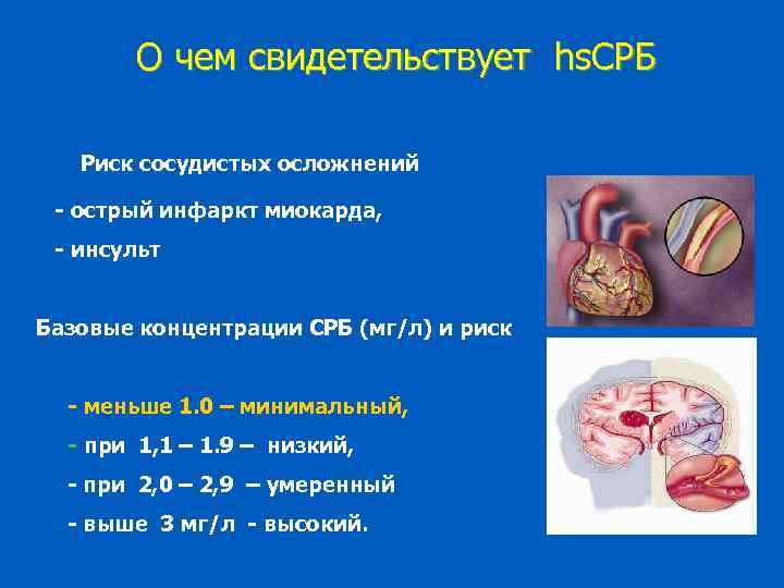 О чем свидетельствует hs. СРБ Риск сосудистых осложнений - острый инфаркт миокарда, - инсульт