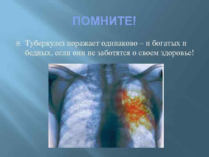 ПОМНИТЕ! Туберкулез поражает одинаково – и богатых и бедных, если они не заботятся о