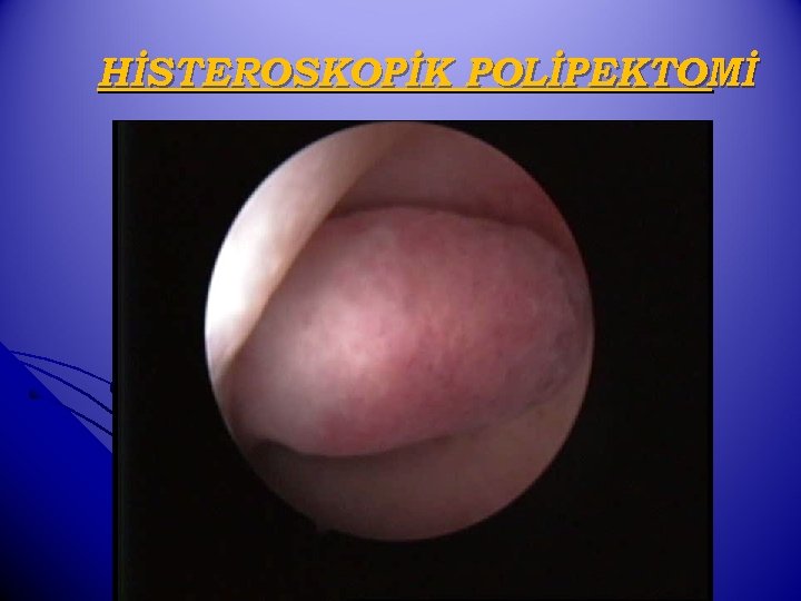 HİSTEROSKOPİK POLİPEKTOMİ 