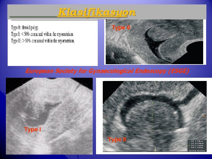 Klasifikasyon Type 0 n. Type 0 European Society for Gynaecological Endoscopy (ESGE) Type II