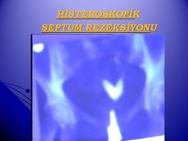 HİSTEROSKOPİK SEPTUM REZEKSİYONU 