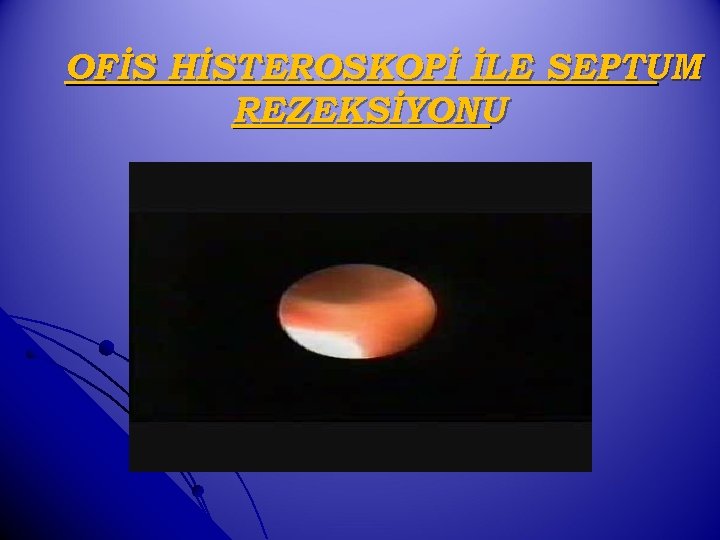 OFİS HİSTEROSKOPİ İLE SEPTUM REZEKSİYONU 