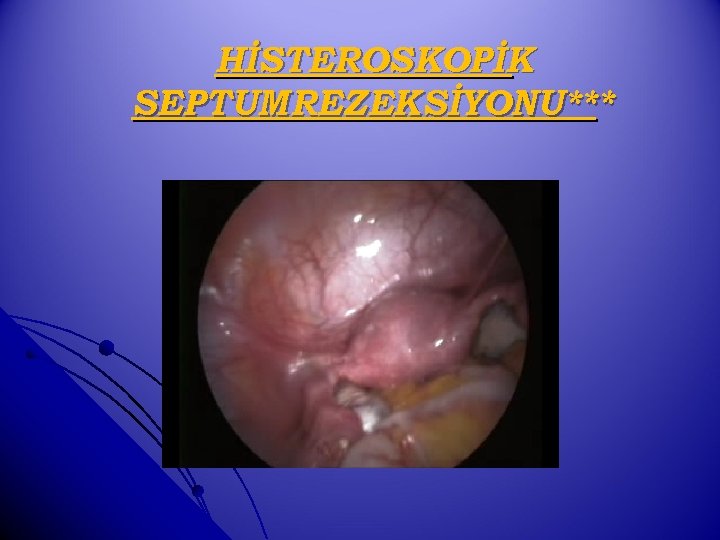 HİSTEROSKOPİK SEPTUM REZEKSİYONU*** 