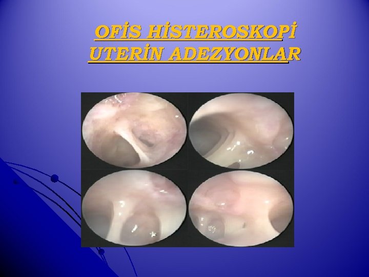OFİS HİSTEROSKOPİ UTERİN ADEZYONLAR 