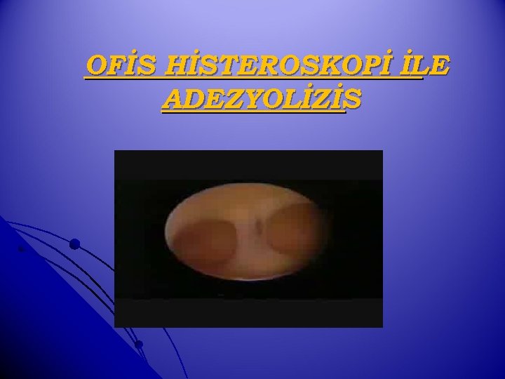 OFİS HİSTEROSKOPİ İLE ADEZYOLİZİS 