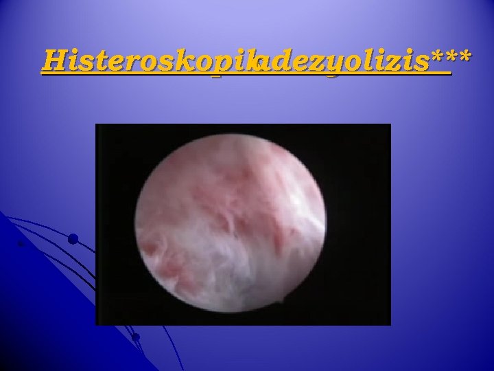 Histeroskopik adezyolizis*** 