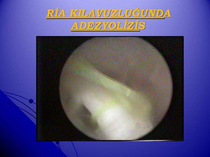 RİA KILAVUZLUĞUNDA ADEZYOLİZİS 