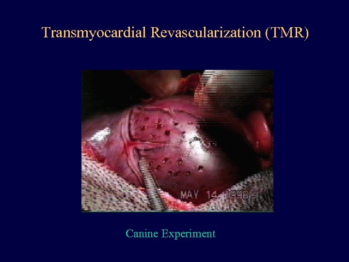Transmyocardial Revascularization (TMR) Canine Experiment 