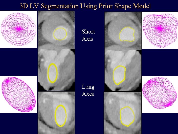 3 D LV Segmentation Using Prior Shape Model Short Axis Long Axes 