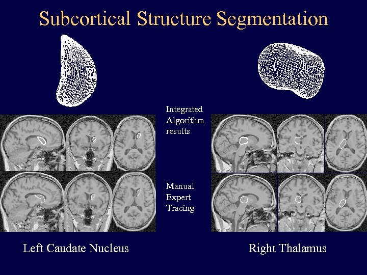 Subcortical Structure Segmentation Integrated Algorithm results Manual Expert Tracing Left Caudate Nucleus Right Thalamus