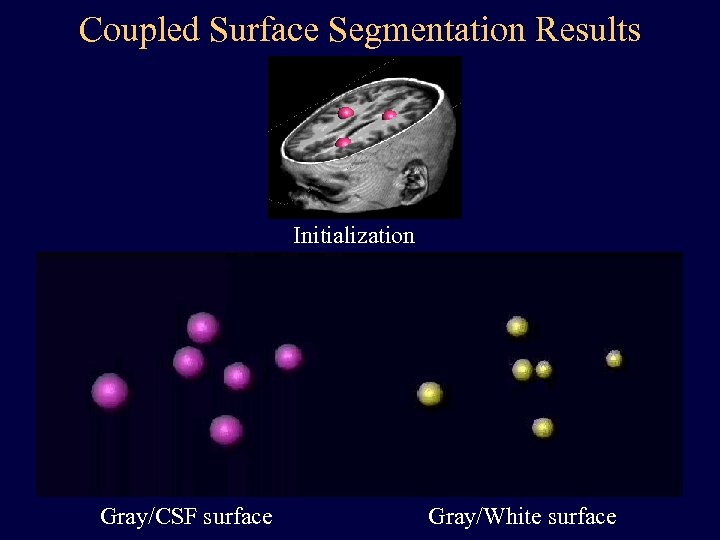 Coupled Surface Segmentation Results Initialization Gray/CSF surface Gray/White surface 