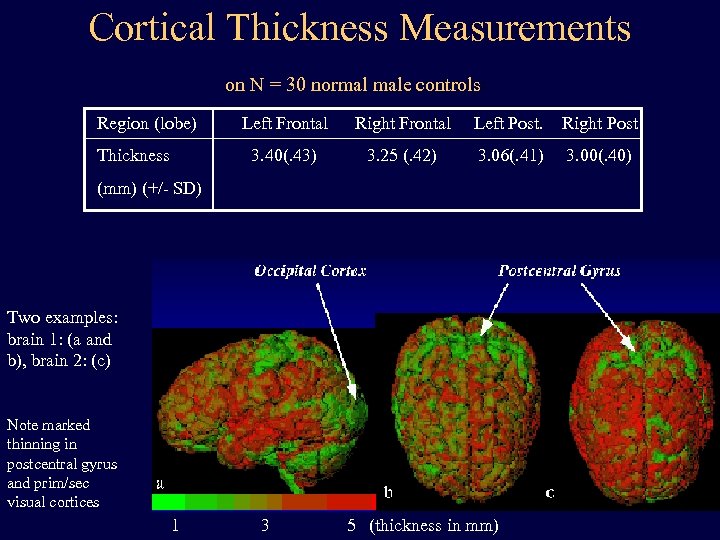 Cortical Thickness Measurements on N = 30 normal male controls: Region (lobe) Right Frontal