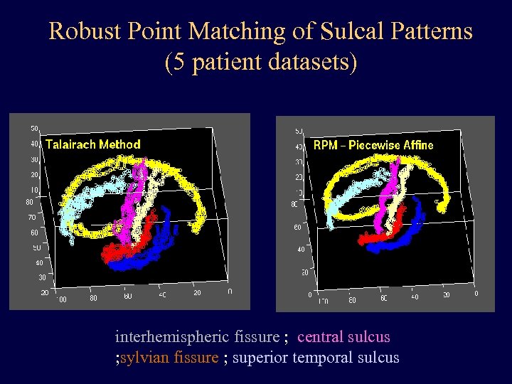 Robust Point Matching of Sulcal Patterns (5 patient datasets) interhemispheric fissure ; central sulcus
