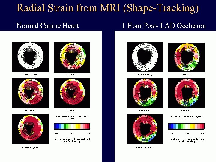 Radial Strain from MRI (Shape-Tracking) Normal Canine Heart 1 Hour Post- LAD Occlusion 