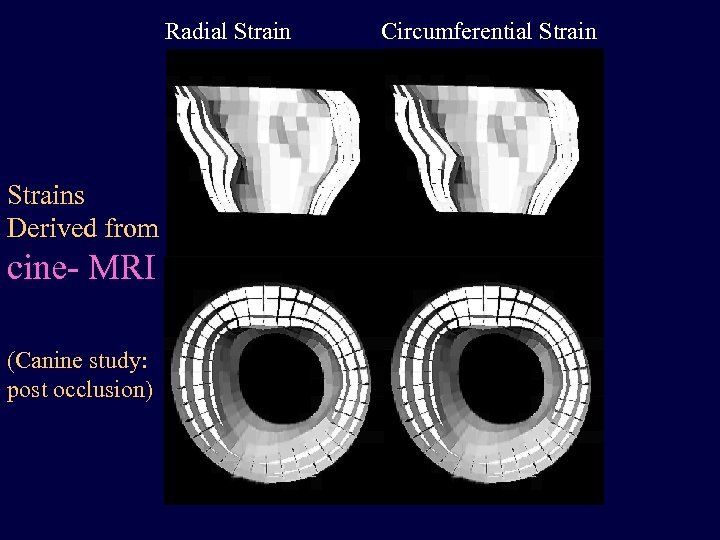 Radial Strains Derived from cine- MRI (Canine study: post occlusion) Circumferential Strain 