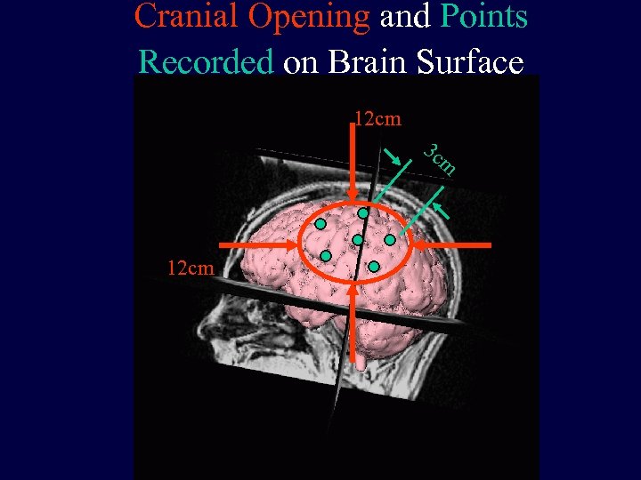 Cranial Opening and Points Recorded on Brain Surface 12 cm 3 c m 12