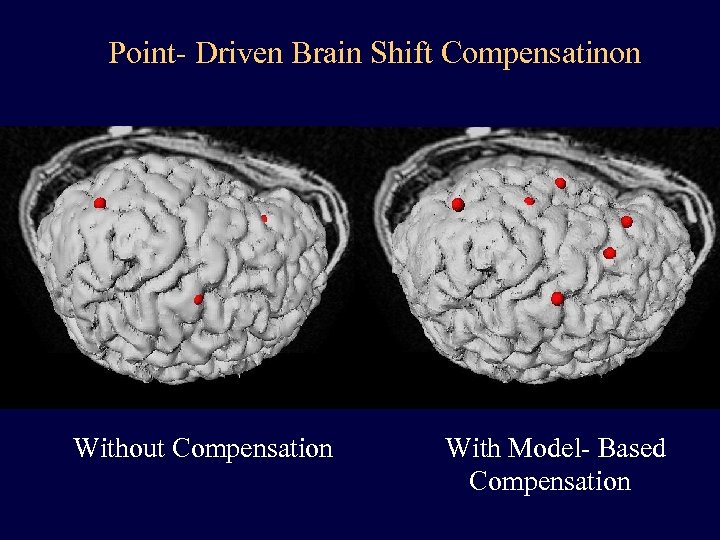 Point- Driven Brain Shift Compensatinon Without Compensation With Model- Based Compensation 