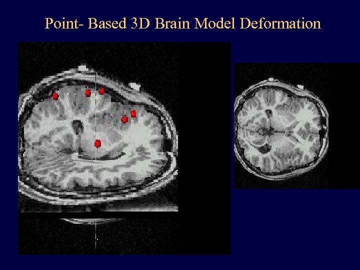 Point- Based 3 D Brain Model Deformation 