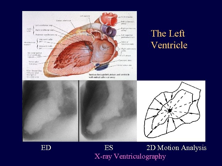 The Left Ventricle ED ES 2 D Motion Analysis X-ray Ventriculography 