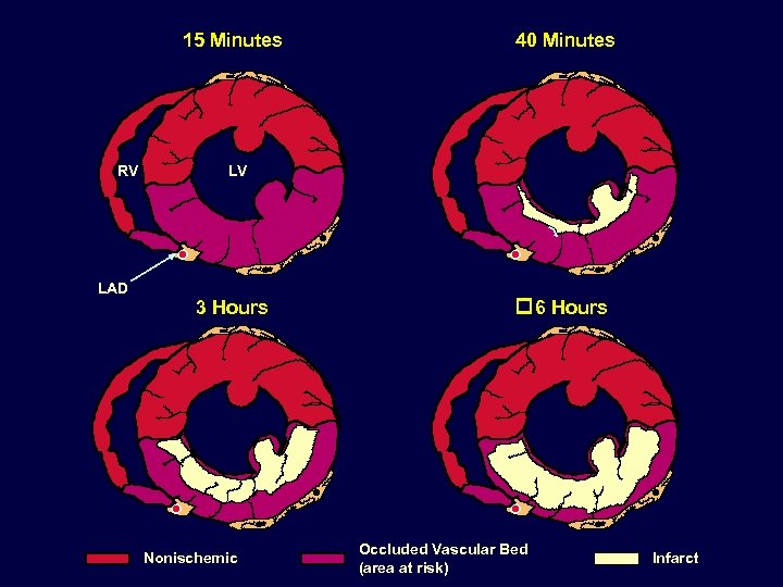 15 Minutes RV LAD 40 Minutes LV 3 Hours Nonischemic 6 Hours Occluded Vascular