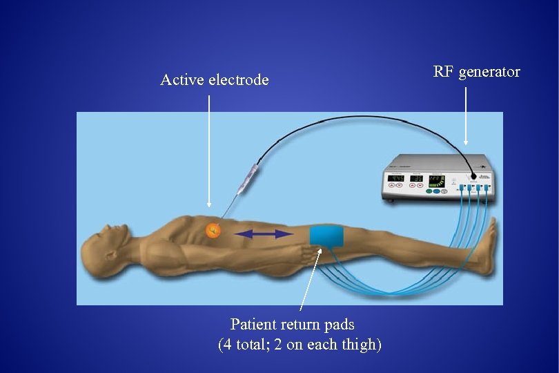 Active electrode Patient return pads (4 total; 2 on each thigh) RF generator 